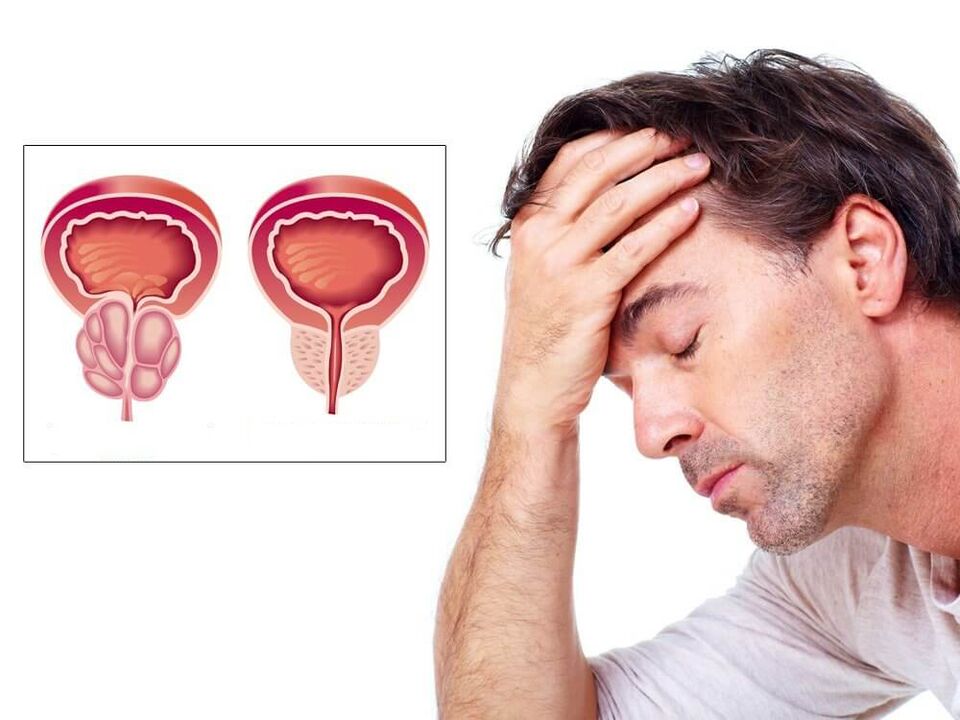 simptomi prostatitisa pri moških