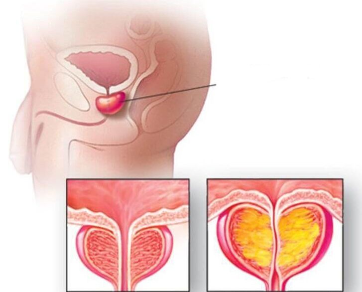 Lokacija prostate, normalna prostata in povečana pri kroničnem prostatitisu