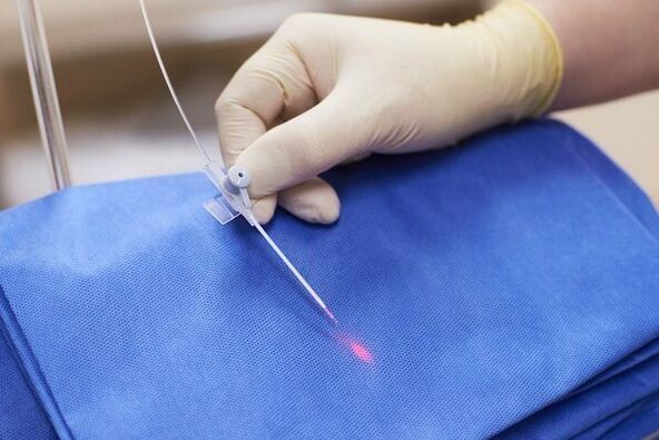 V nekaterih primerih se za kronični prostatitis uporablja laserska terapija