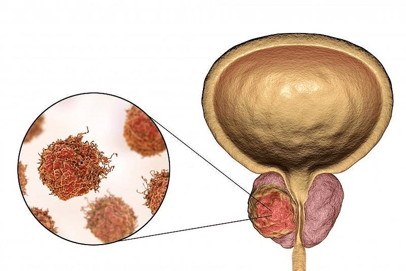 kako izgleda poškodba prostate