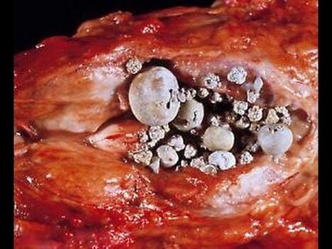 Kalkulozni prostatitis