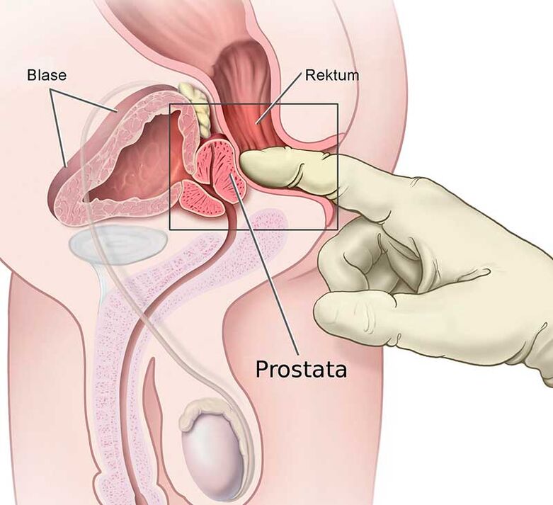 masaža prostate za prostatitis