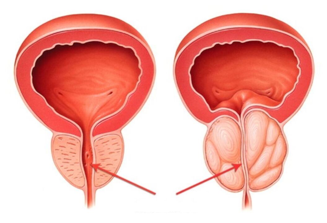 zdrava in vneta prostata s prostatitisom